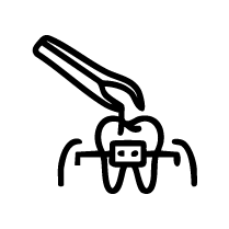 Pre-Orthodontic Extractions